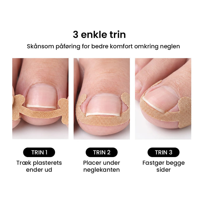 Plaster mod nedgroede negle (12 stk)