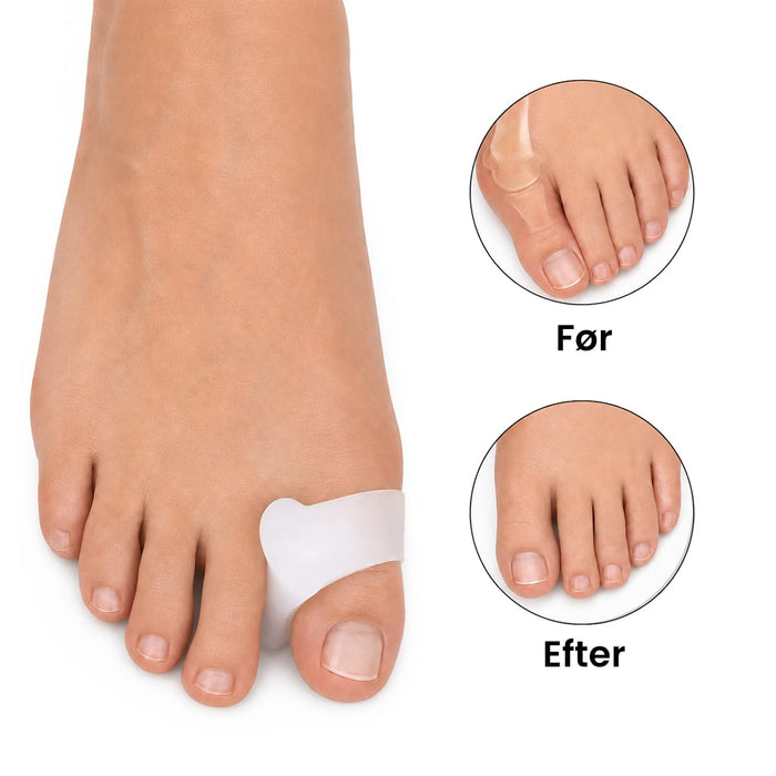 Hallux Valgus tåudjævner